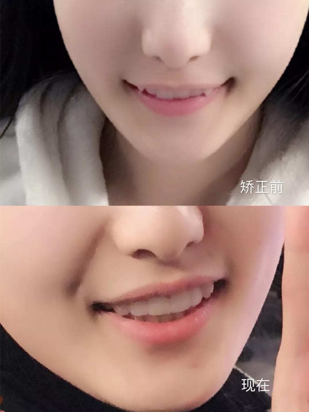 牙齿很整齐拔牙正畸前后效果,虎牙齿矫正的前几天有什么反应