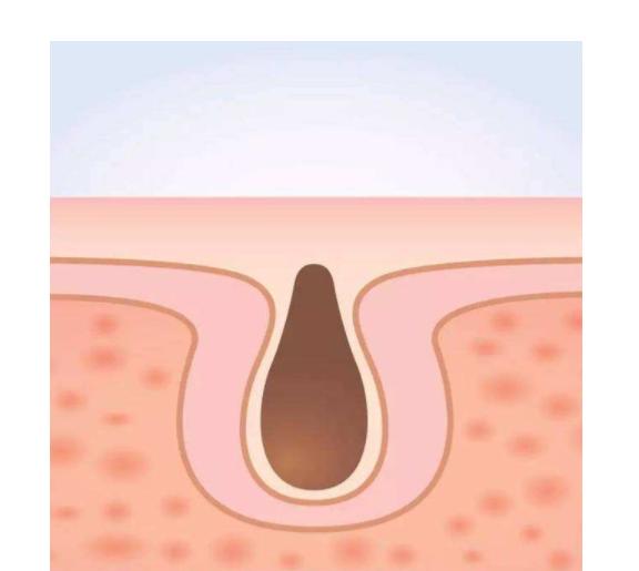 为什么出油要补水,皮肤出油多是因为缺水吗