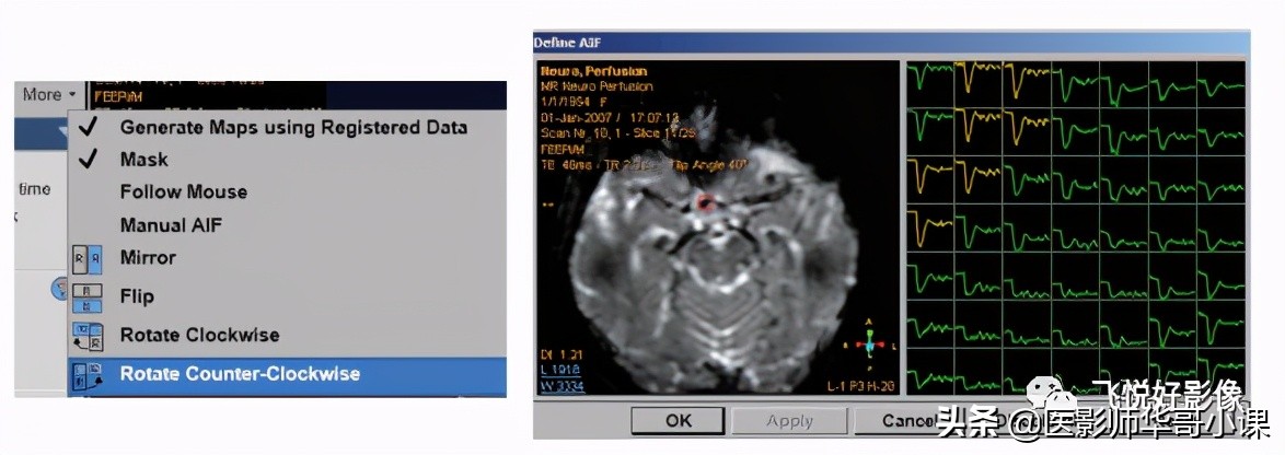 飞利浦磁共振脑灌注怎么测量,飞利浦核磁诊断教学