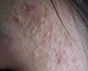 各种痘痘的形成应该如何快速根治,痘痘是怎么形成的原因及解决方法