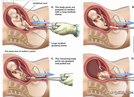 人流术后健康宣教结束总结,人流术后的护理及健康宣教