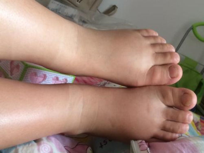 教你十招治疗脚气的方法,治疗脚气的几个误区看你中招了吗