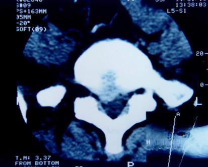 腰椎间盘突出针灸能治彻底吗,腰椎间盘突出针灸治疗能彻底吗