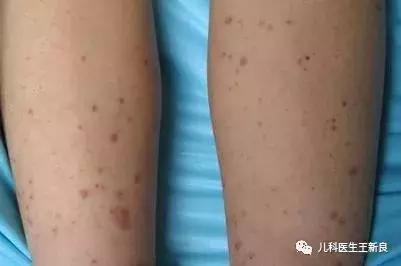 过敏性紫癜和血小板减少性紫癜,过敏性紫癜抽血后腿上紫癜增多