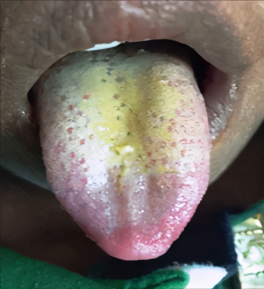 猩红热是幼儿最常见的传染疾病,猩红热可以用疫苗预防吗