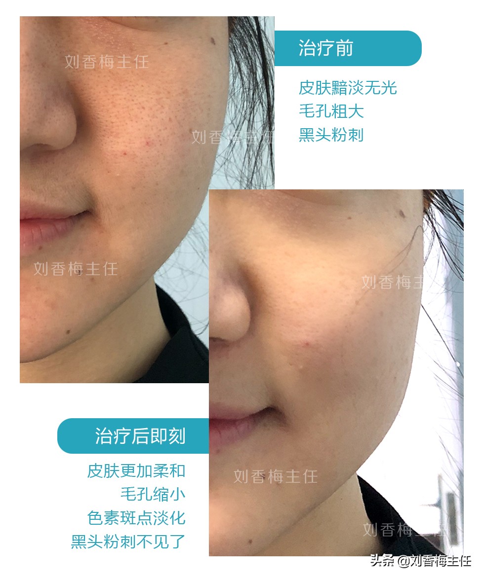 皮肤松弛毛孔粗大黑头多怎么解决,皮肤毛孔粗大怎么解决