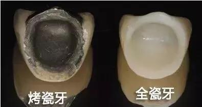 烤瓷牙和全瓷牙的优缺点是什么,钴铬合金烤瓷牙和全瓷牙优缺点