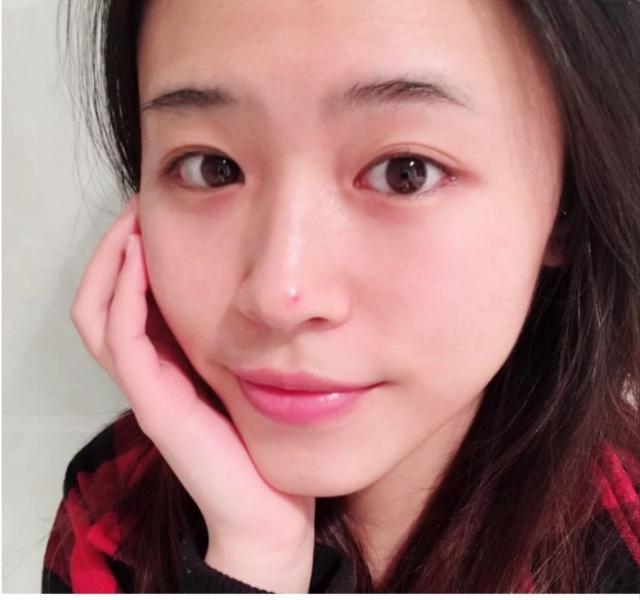 鼻子黑头毛孔粗大怎么去除,鼻子黑头严重毛孔粗大怎么办