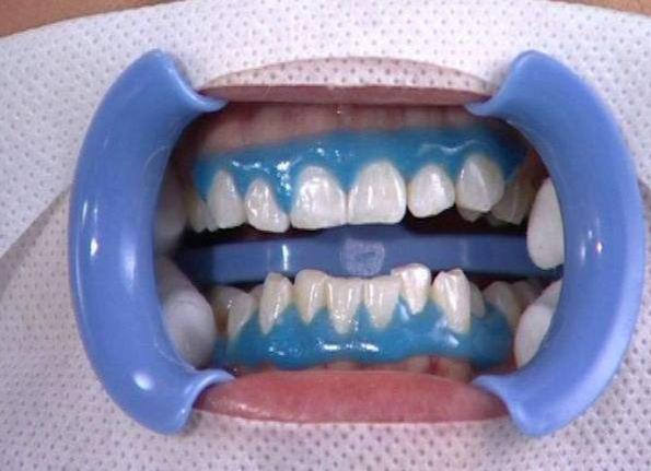 牙齿快速美牙偏方大全图解,美牙真的可以让牙齿变雪白吗