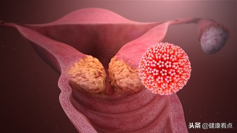 预防艾滋病50讲：性病患者最容易得艾滋病吗？女性尤其要小心