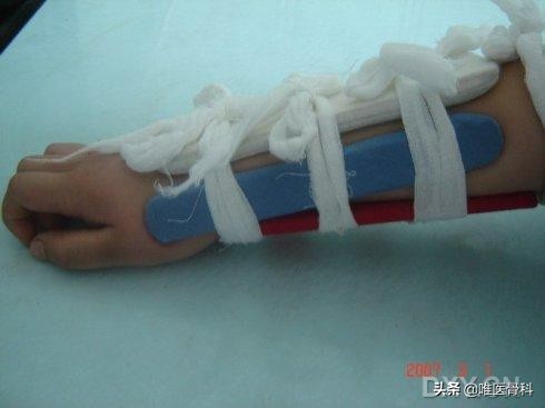 外固定多久恢复,外固定取出一般多久