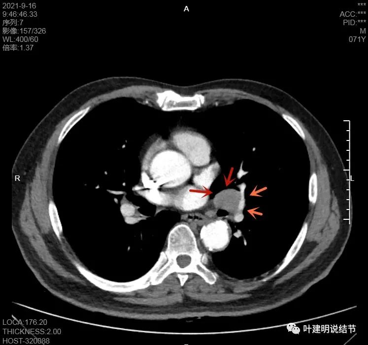 肺上有实性结节6mmx5mm是什么原因,肺上有1.7x1.8的实性结节该怎么办