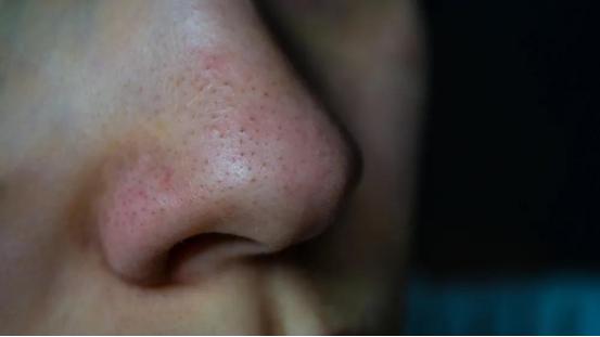 鼻子黑头怎么彻底解决,鼻子黑头最简单的消除方法