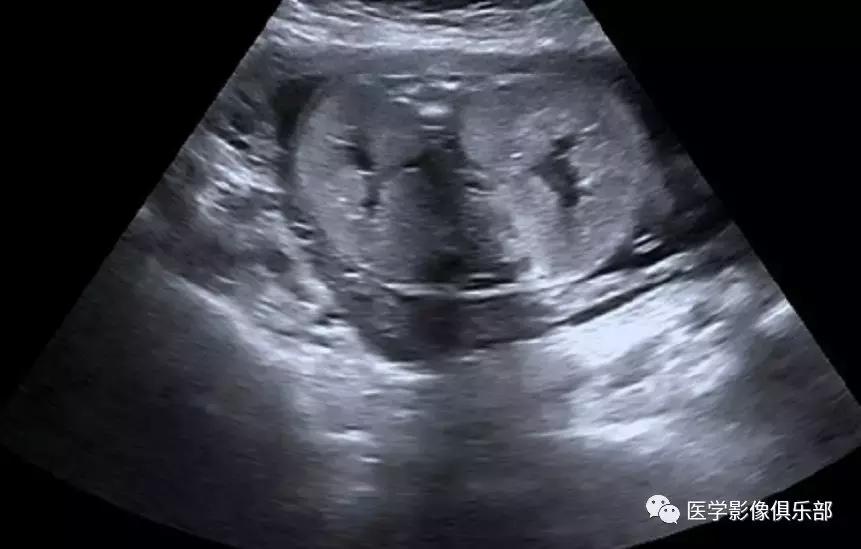 双肾多发小囊肿到底是不是多囊肾,肾多发囊肿与多囊肾的超声鉴别