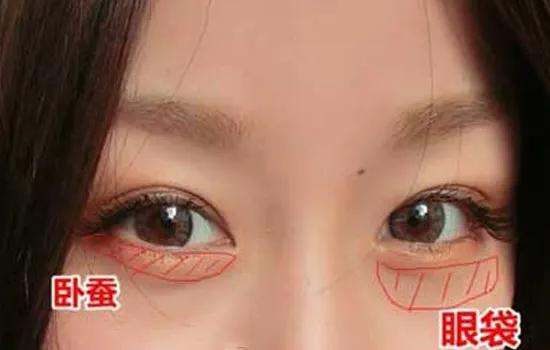 眼袋怎么变卧蚕整形图片,外切眼袋保留卧蚕怎么没有卧蚕呢
