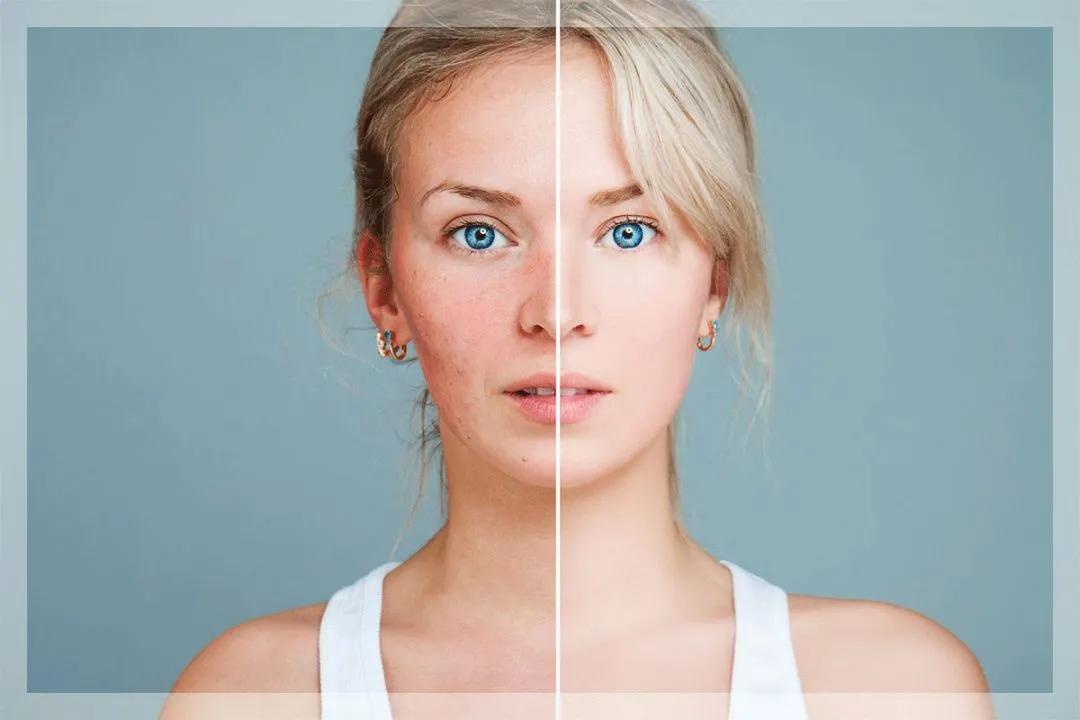 皮肤干燥暗沉长痘闭口,脸上的三角区老是长痘起干皮