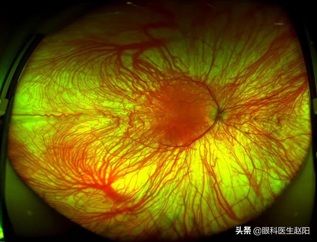 红光治疗仪使用注意事项！近视防控纯干货分享