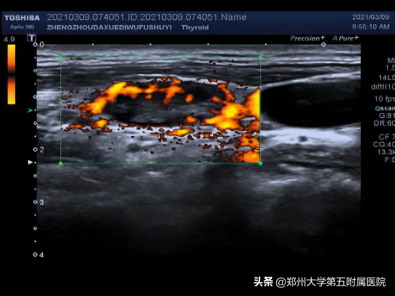 有一个小小的淋巴结,淋巴结有小尾巴