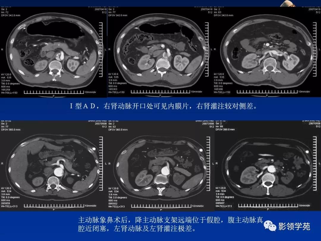 主动脉夹层壁间血肿如何鉴别,主动脉夹层血肿溃疡