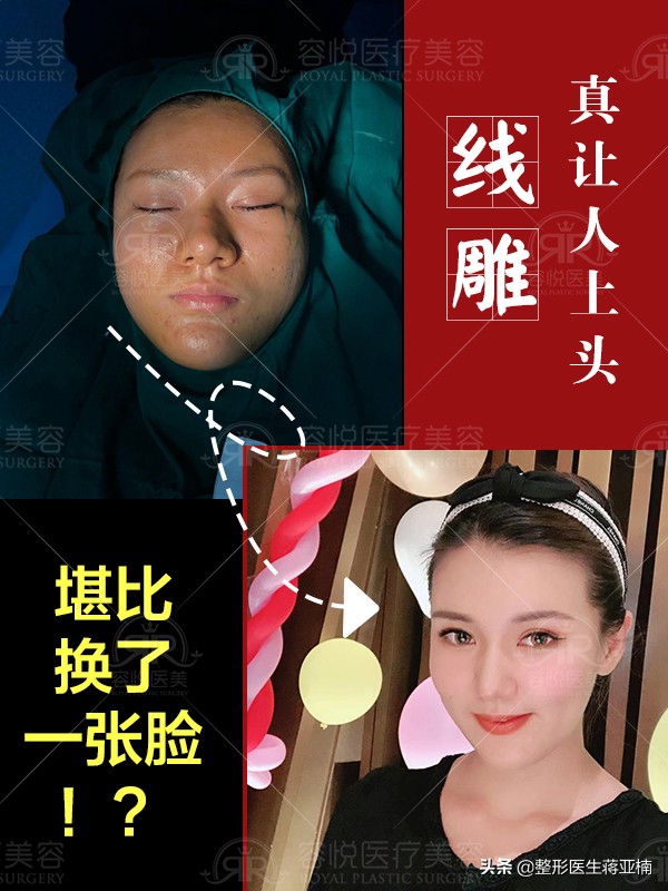 线雕完觉得自己像阿凡达,线雕的真实感受图片