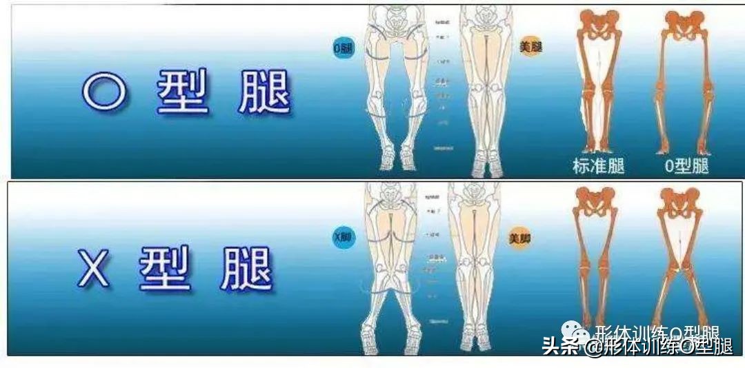 o型腿和罗圈腿图片对比,o型腿和罗圈腿的区别