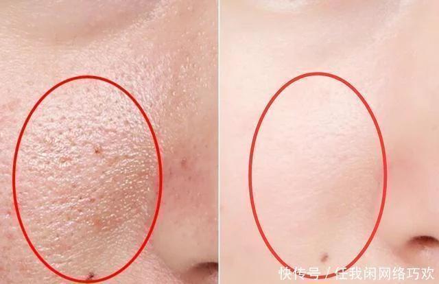 满婷除螨皂去黑头,美容除螨去黑头