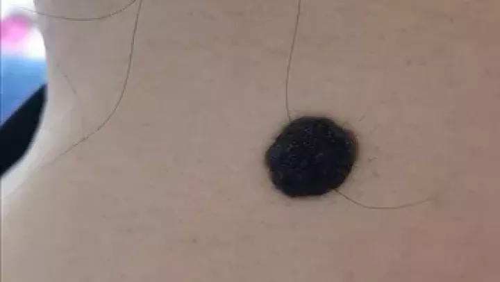 哪些部位长痣预示一生劳碌,痣的位置预示着什么