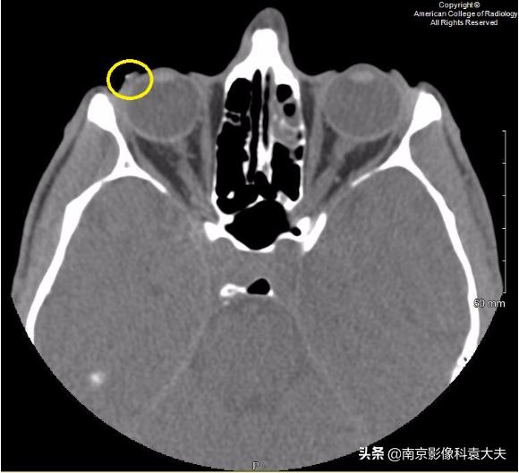 一39岁男子争吵后，右眼突然瞎了，病例分析知答案