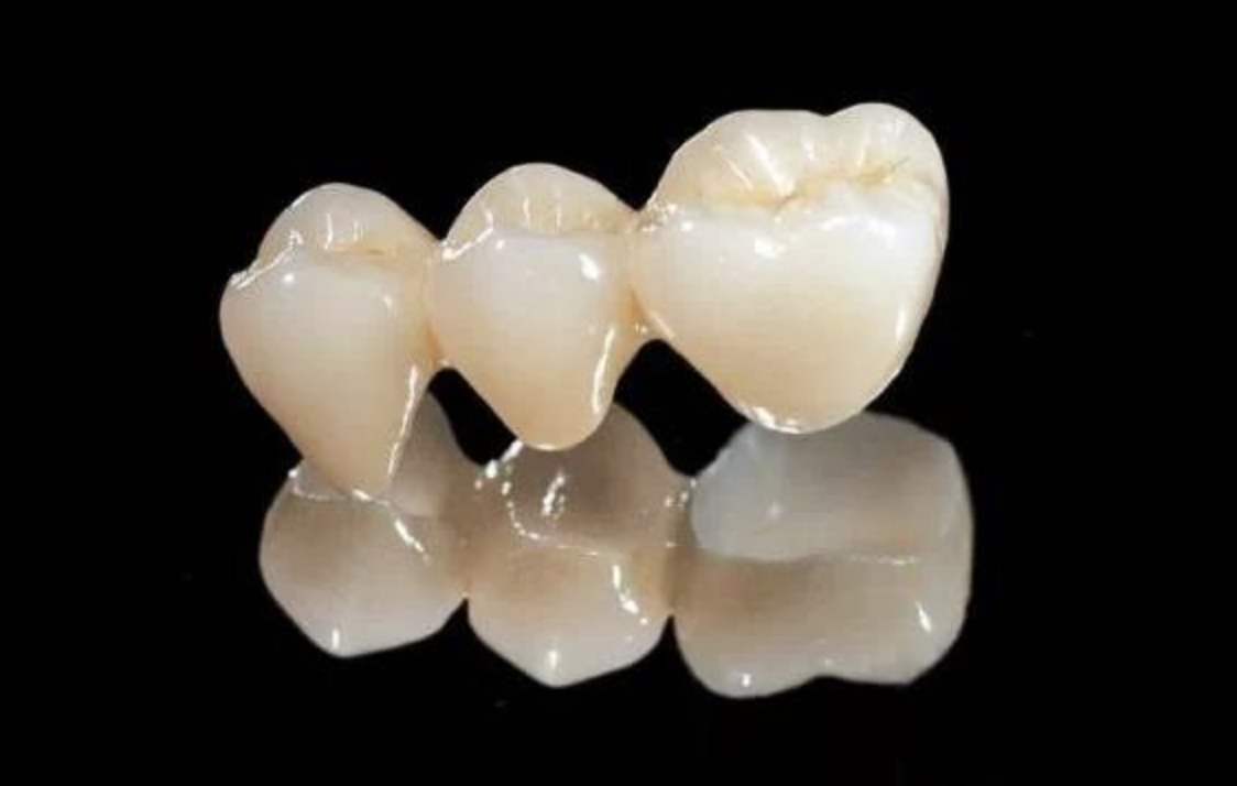 全瓷牙和金属烤瓷牙哪个容易崩瓷,含金属烤瓷牙套好还是全瓷牙套好