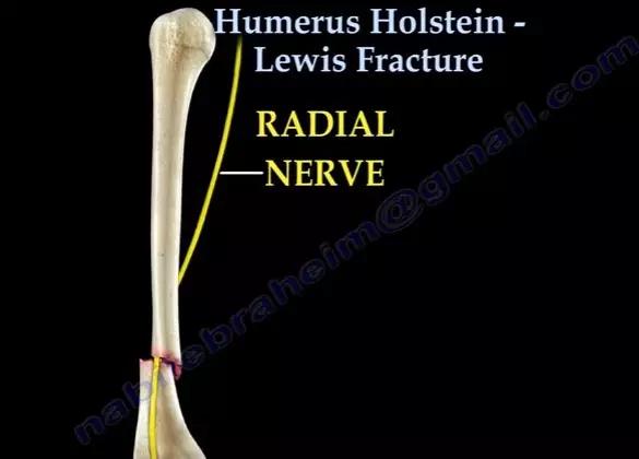 所有骨折都叫什么名字,骨折的名称有哪些