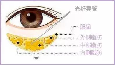 去眼袋最好的方法小红书,消除眼袋的护肤品安利
