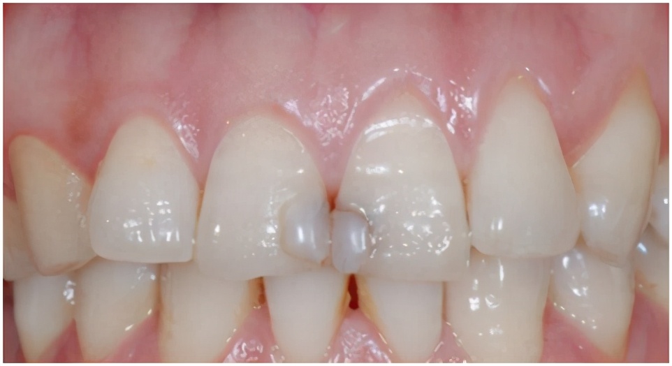 600补一颗牙齿贵吗,诊所补一颗牙多少钱