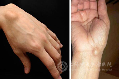 身上有个硬包怎么判定是肿瘤,身上有肿块一定是肿瘤吗