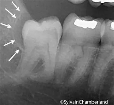 拔智齿痛到怀疑人生,拔了智齿痛的怀疑人生