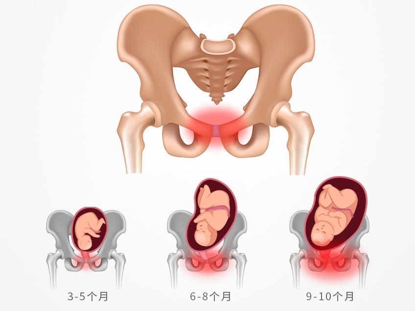 孕妇耻骨疼痛怎么能缓解,怎么缓解耻骨疼痛走路都不能走
