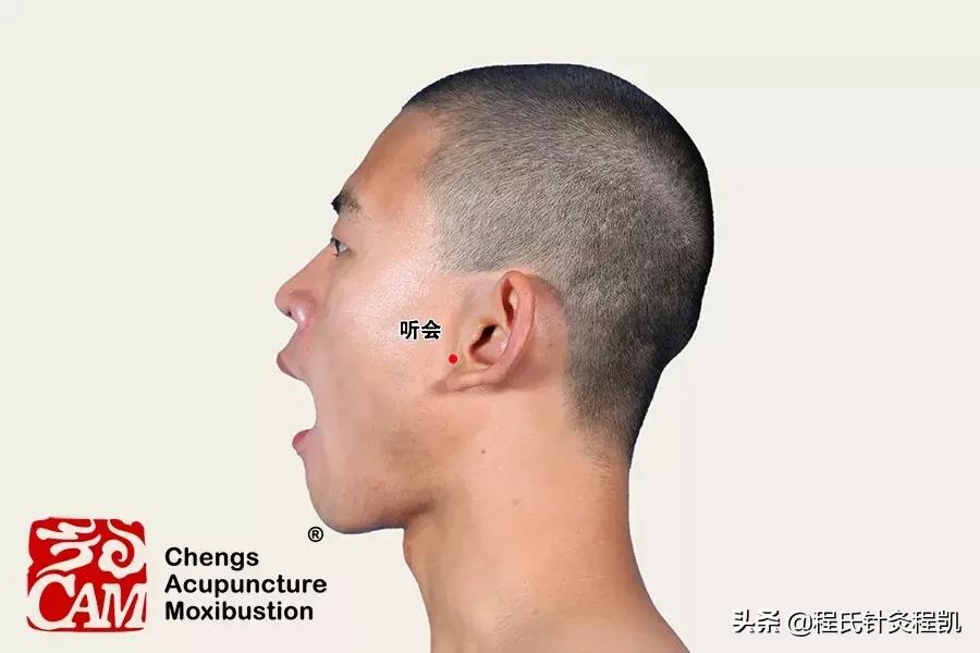 中医治疗耳鸣的效果怎么样,感冒耳鸣怎么快速消除按哪个穴位