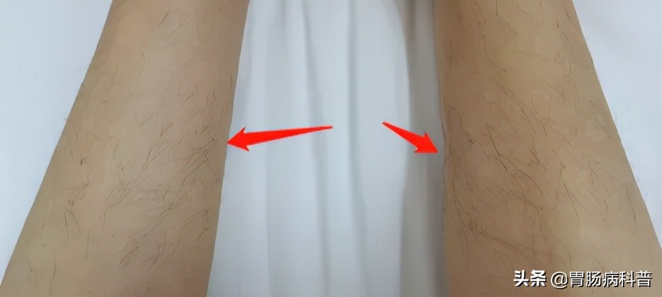 70岁老太太患上了癌症,老年人双下肢长出黑毛毛