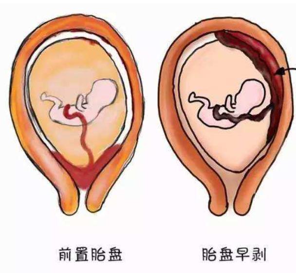 怎样解决孕期出血,孕期阴道出血的症状