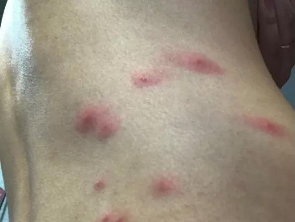 扁平疣和黑色素痣区别,疣与色素痣的区别