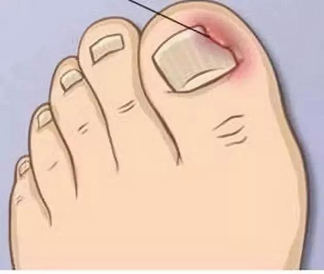 脚趾甲总往肉里长怎么矫正,嵌甲旁边的肉怎么消除