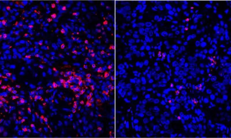 胰腺导管腺癌是最严重的癌症吗,为什么胰腺容易得癌