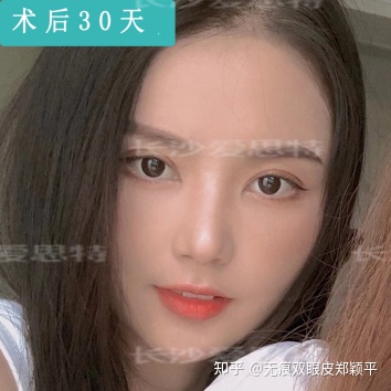 可以只开眼角不割双眼皮吗,双眼皮到底要不要开眼角