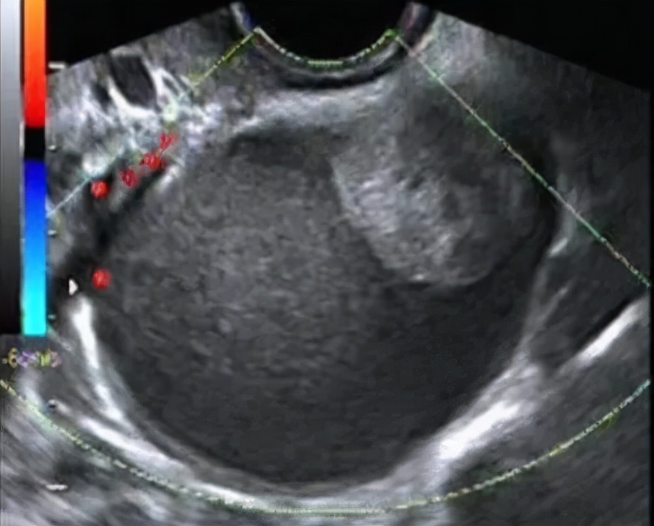 体检卵巢有个囊肿要紧不要紧,体检卵巢囊肿什么原因