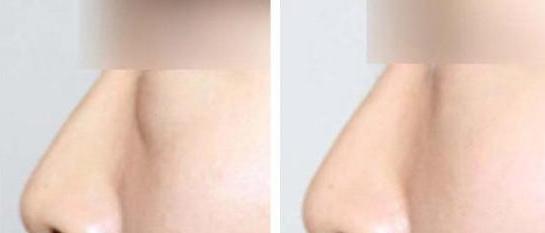 鱼尾纹眼袋怎么去除最有效,眼袋鱼尾纹怎么去除简单方法