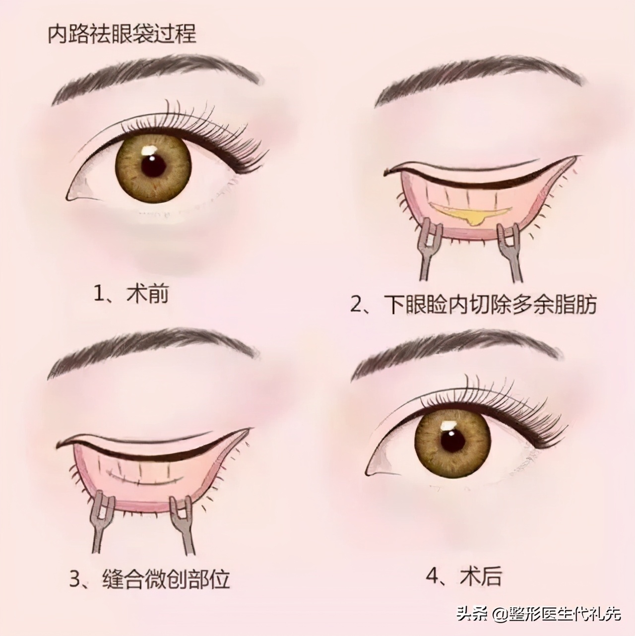 外切祛眼袋和内切祛眼袋哪个好些,超声祛眼袋好还是射频祛眼袋好呢