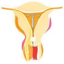 职责在身，岂敢疏懒：腺肌症近期问题汇总呈现