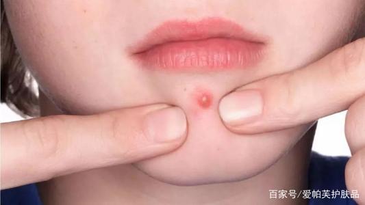 如何从根源上解决痘痘的问题,不同类型的痘痘有不同的改善方法