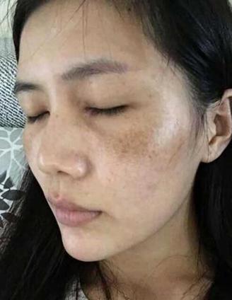 不规则黄褐色斑什么引起的,黄褐色斑是什么原因引起的