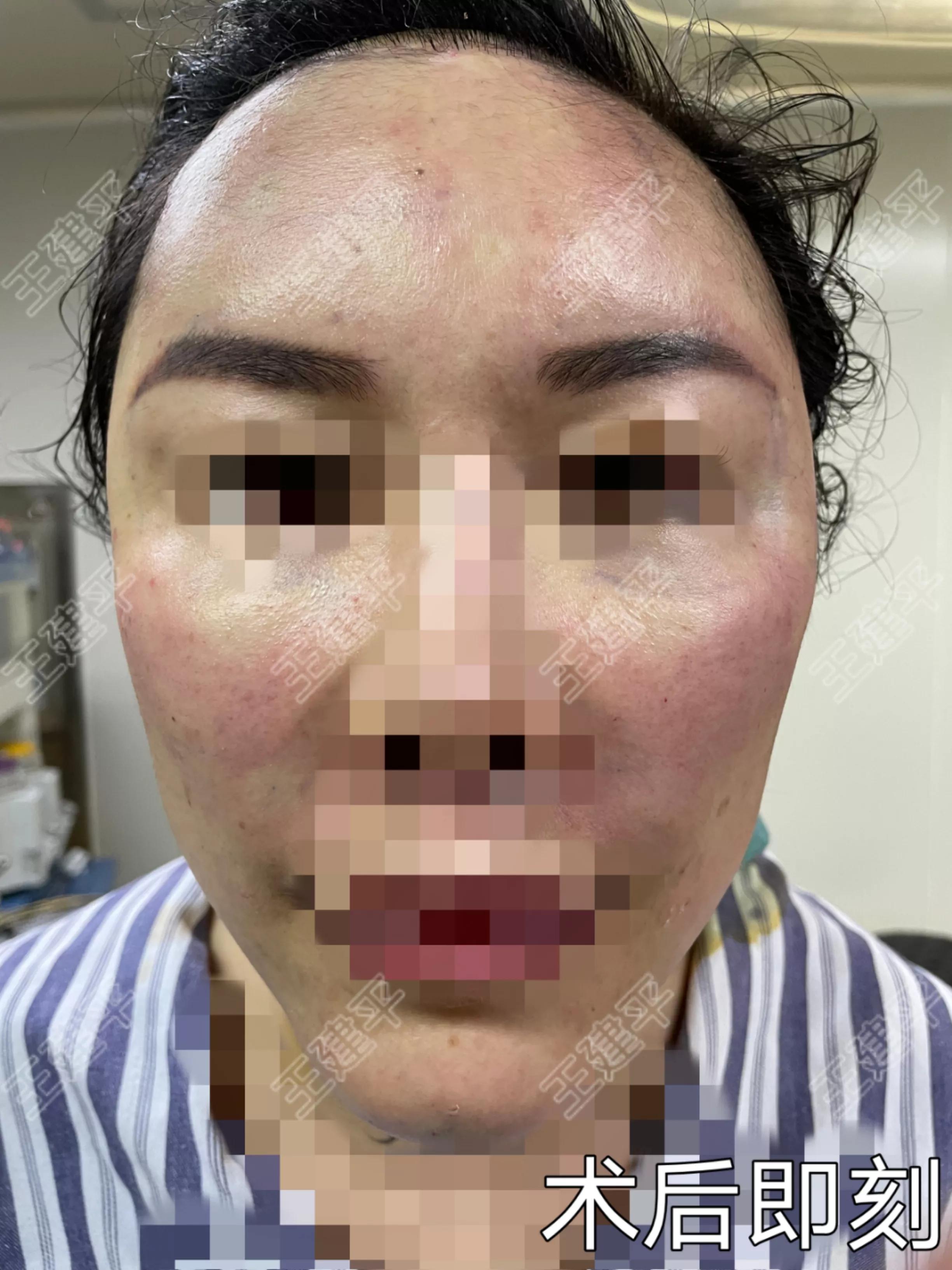 全脸填充真实视频,全脸填充是什么