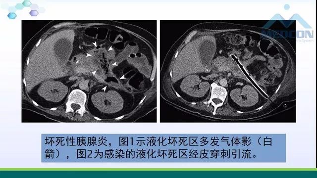急性胰腺炎的护理措施,急性胰腺炎影像与临床